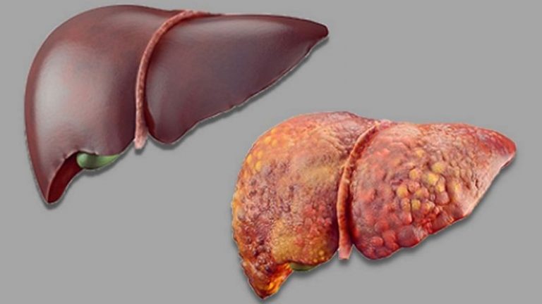 Warning signs of a damaged liver from alcohol overconsumption