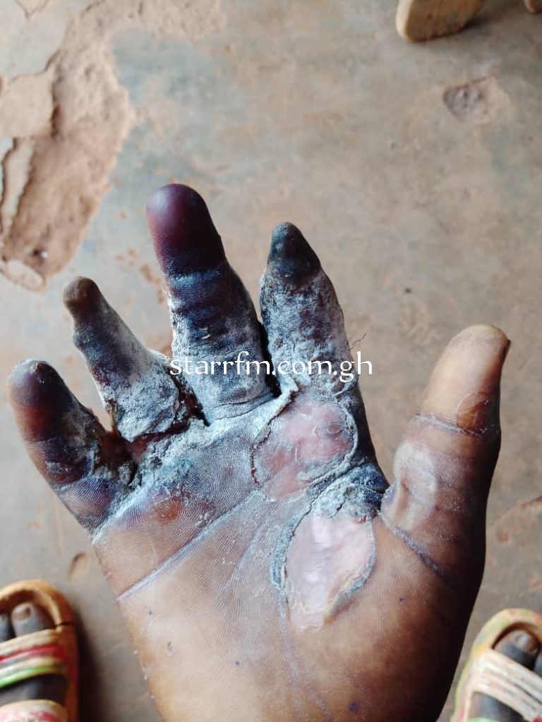 Boy, 17 losing fingers after “Pastor” scalds palm over missing Ghc600