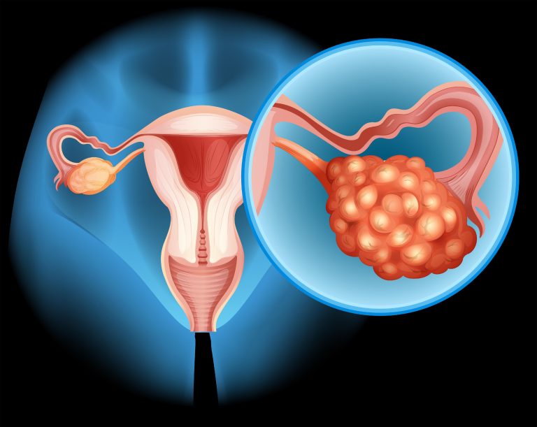 Here are some important facts to know about ovarian cancer.