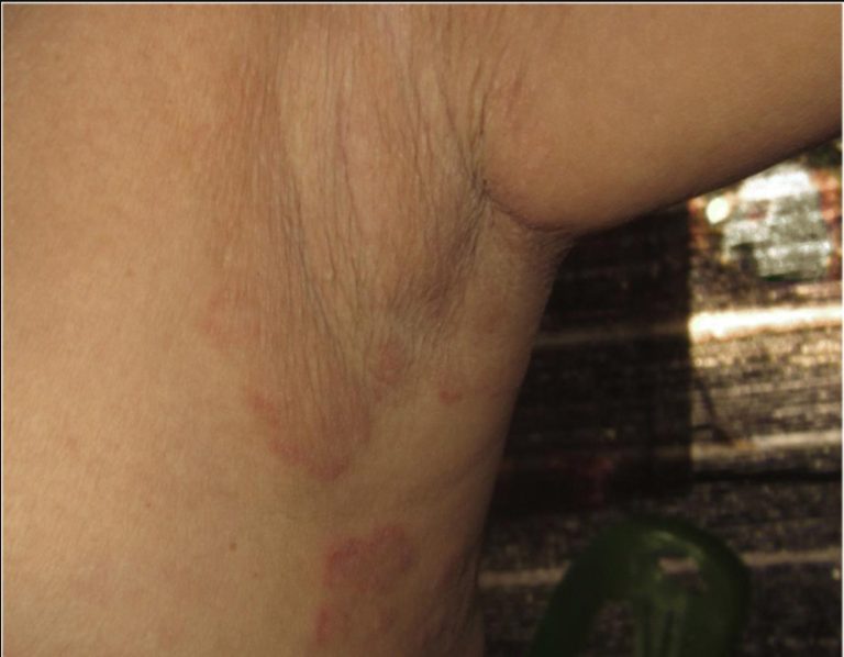 Skin Neglected Tropical Diseases