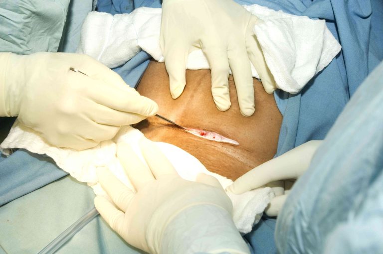 Caesarean Section