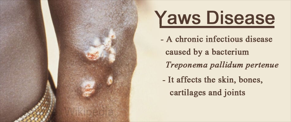 Yaws Disease