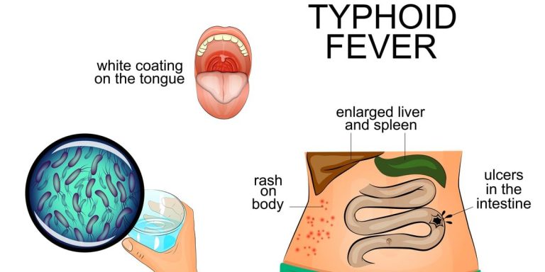 GHS confirms surge in Typhoid cases in Oti Region