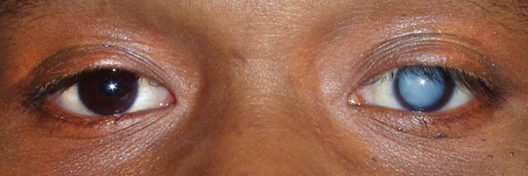 165,000 people currently blind in Ghana due to cataract