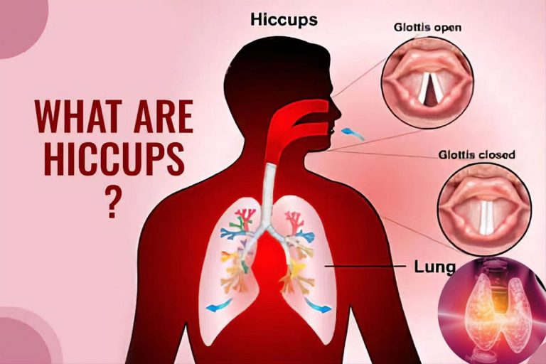 Why We Get Hiccups and Ways to End Them