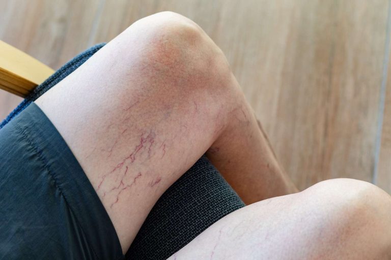 Skin Bleeding and Bruising: What Triggers Sudden Changes